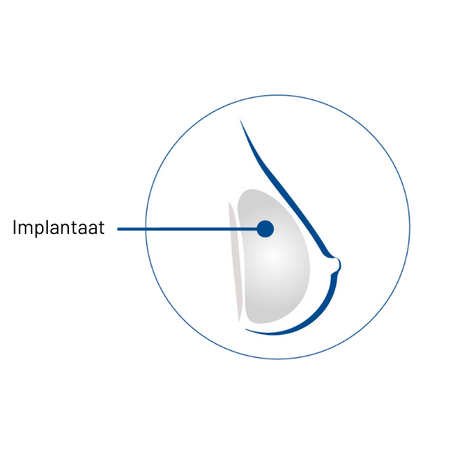 Implant Icon